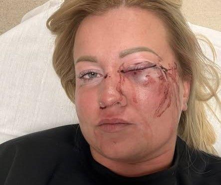 Fél szemére megvakulhat az a nő, akit állítása szerint megvert Szentmártonkáta alpolgármestere 